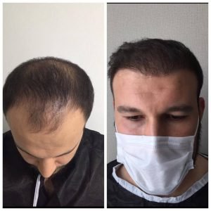 hair-transplant-istanbul-turkey-before-after
