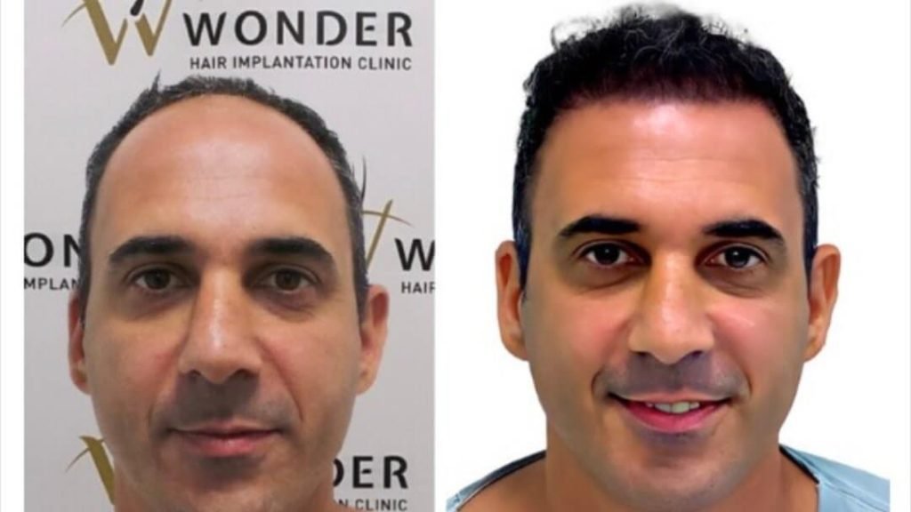 hair-transplant-turkey-before-after-1