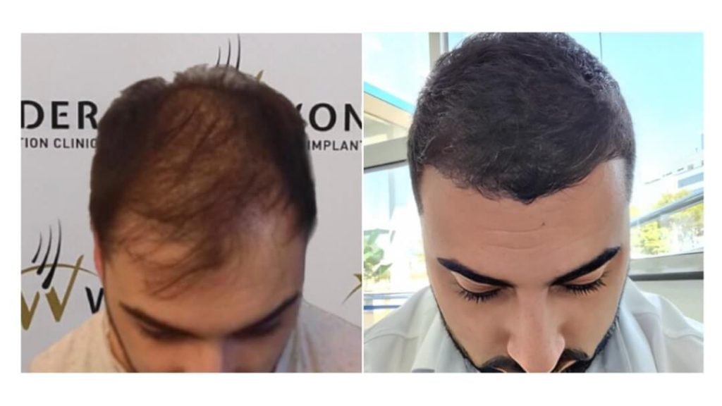 hair-transplant-turkey-before-after-10