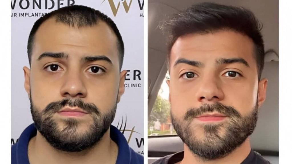 hair-transplant-turkey-before-after-12