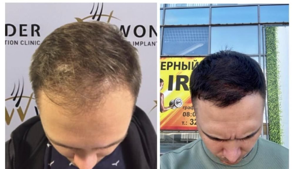 hair-transplant-turkey-before-after-13
