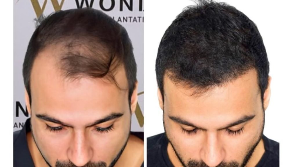 hair-transplant-turkey-before-after-14