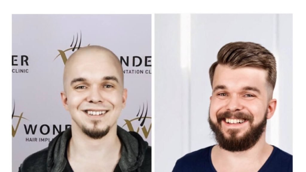 hair-transplant-turkey-before-after-19