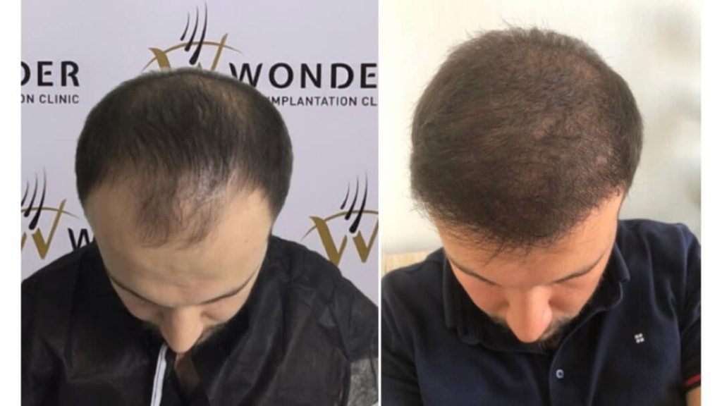 hair-transplant-turkey-before-after-20