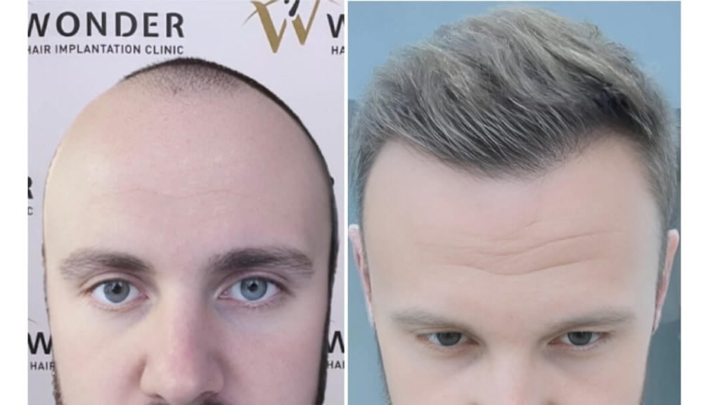 hair-transplant-turkey-before-after-3