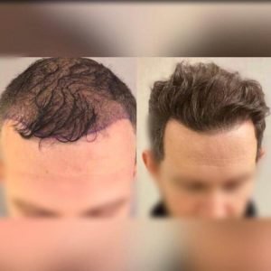 hair-transplant-turkey-before-after