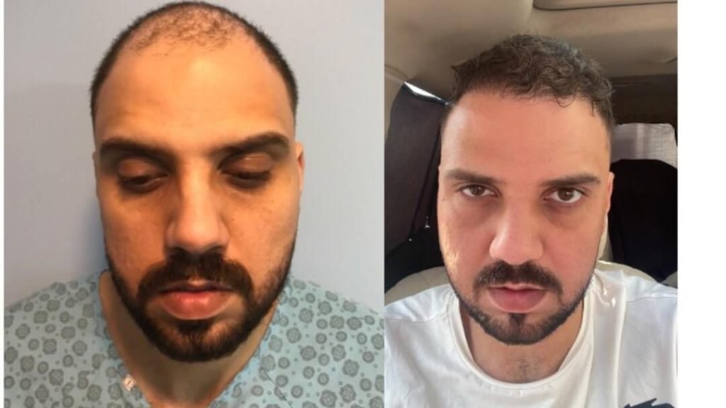 hair-transplant-turkey-before-after-4