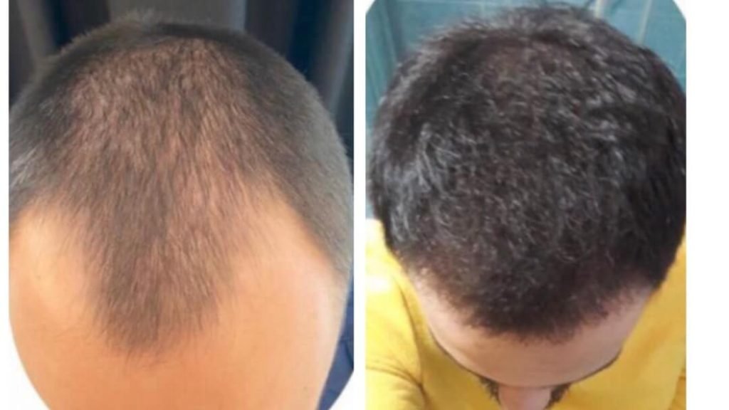 hair-transplant-turkey-before-after-5