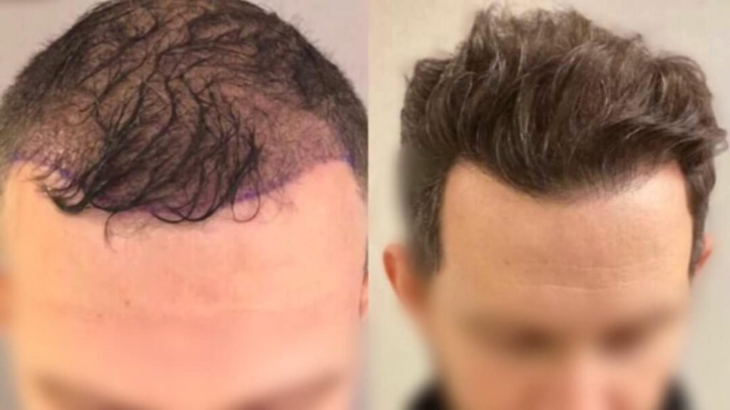 hair-transplant-turkey-before-after-6