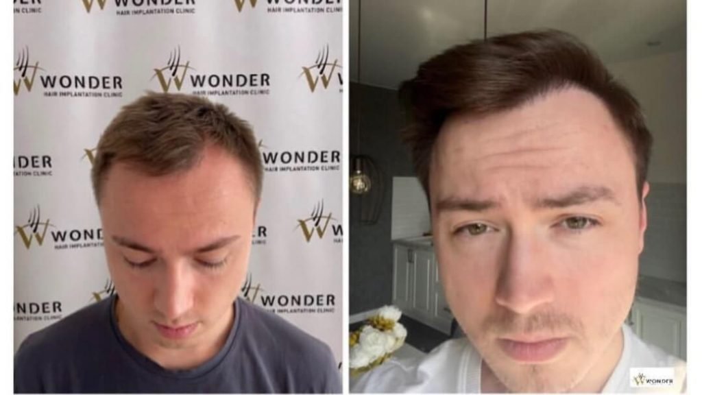 hair-transplant-turkey-before-after-7