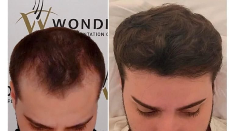hair-transplant-turkey-before-after-9