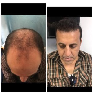 hair-transplant-turkey-before-after-photo