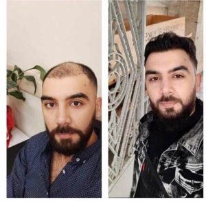 hair-transplant-turkiye-berfore-after
