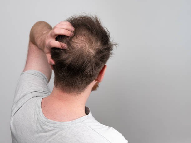 How to Treat Balding Crown?