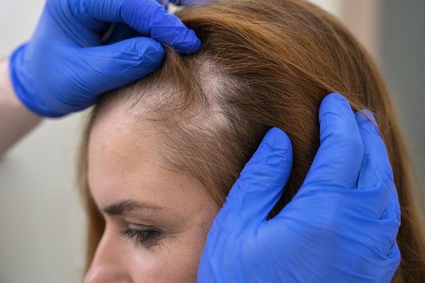 hair transplant for women